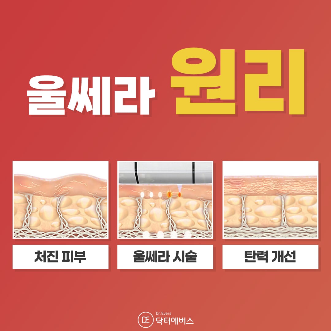 울쎄라리프팅 수원피부과 닥터에버스