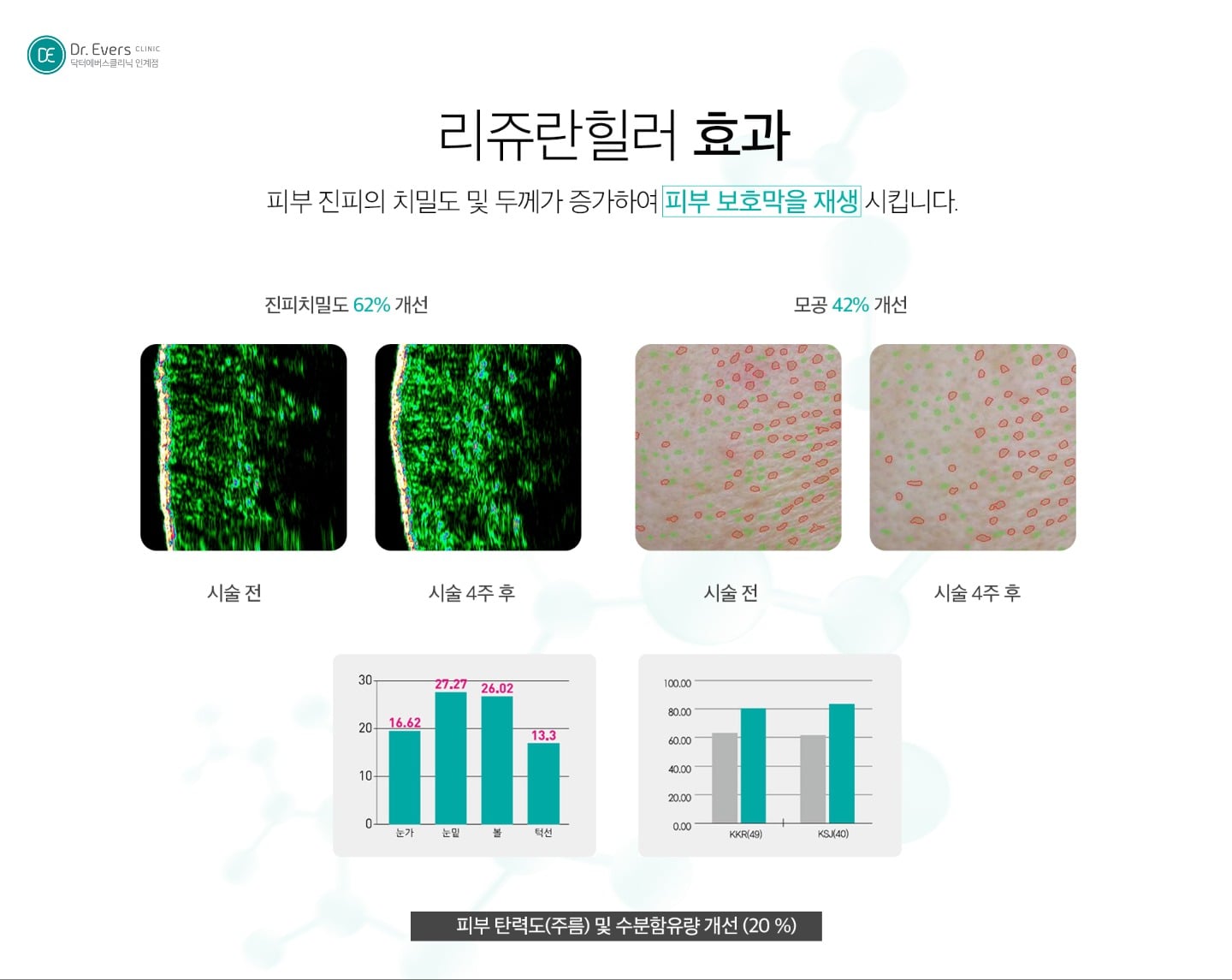 스킨부스터 시술의 원리와 안전성 — 닥터에버스의원 수원인계점